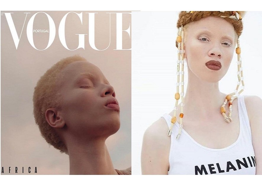 South African Lawyer Becomes First Model With Albinism To Cover Vogue